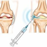 Хондропротекторы препараты для лечения артроза