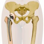 Коксартроз современные методы лечения