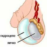 Нетрадиционные методы лечения водянки яичка