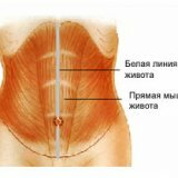 Грыжа белой линии живота