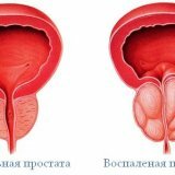 Причины возникновения камней простаты