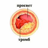 Что приводит к образованию тромбов и тромбоэмболии