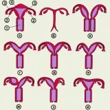 Как аномальное развитие матки влияет на репродукцию