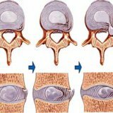 Причины возникновения межпозвоночной грыжи