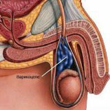 Развитие варикоцеле и лечение заболевания