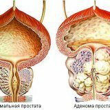 Заболевание аденома предстательной железы