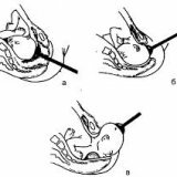 Вакуум экстракция плода во время родов