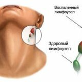 Правильное лечение воспаления лимфоузлов