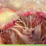 Изменение клапанов сердца при ревматизме