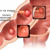 Заболевание полипоз толстой кишки