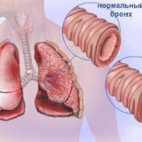 Виды симптомы и методы лечения бронхитов