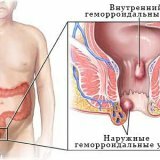 Медикаментозное лечение геморроя у человека