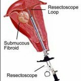 Хирургическое лечение заболеваний матки гистерорезектоскопия