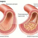 Что такое атеросклероз и как его избежать